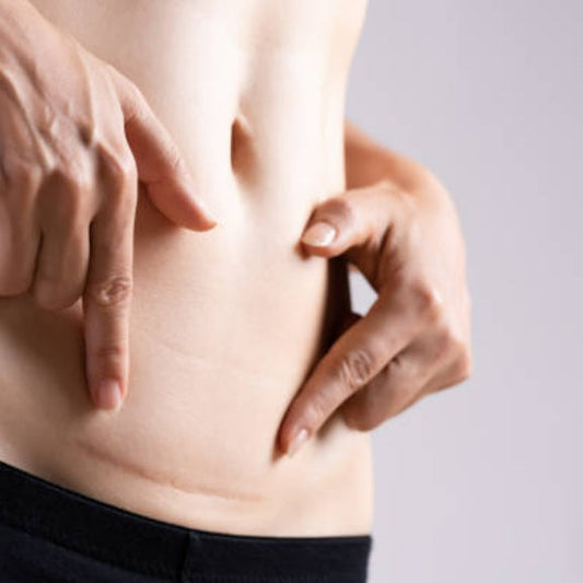 cicatrice césarienne